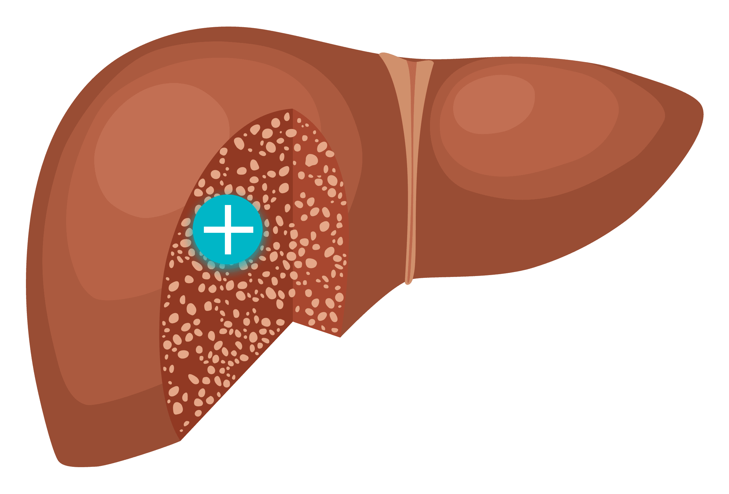 Image of fibrosis liver